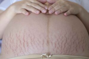 Argan Oil for Pregnancy Stretch Marks